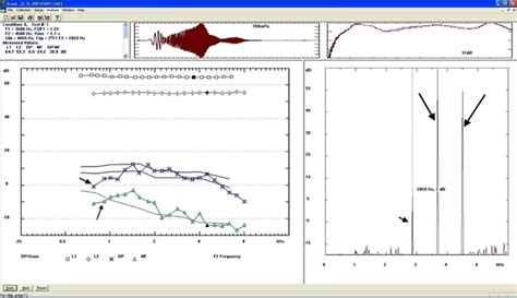 oae test results interpretation|Otoacoustic Emissions: Overview, Recording, Interpretation .